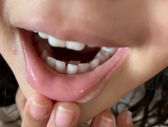 dente permanente nascendo atrás do dente de leite